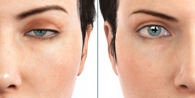 Kelopak Mata Turun atau Kendor Tidak Hanya Dialami Oleh Orang Tua Saja!