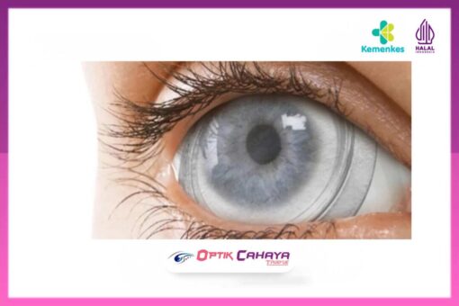 Bandage Contact Lens